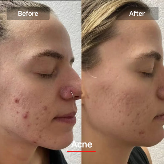 Healix® Redlight Therapy Mask